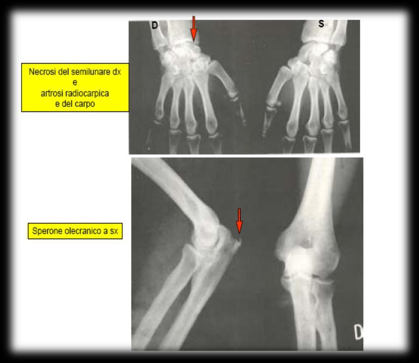 SINDROME DA VIBRAZIONI MANO BRACCIO lesioni muscoloscheletriche Lesioni tendinee: tendinite dei muscoli flessori della mano Lesioni osteoarticolari: