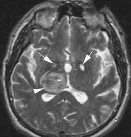 T2: iperintensità del Pallido e