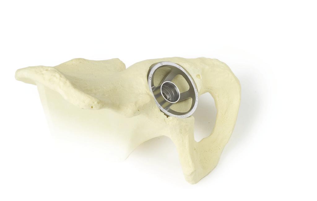 Cotile Zimmer Maxera Tecnica Chirurgica 9 Nota: E fondamentale rimuovere tutti gli osteofiti presenti sul bordo dell acetabolo che possono impedire il raggiungimento del fondo dell acetabolo e l