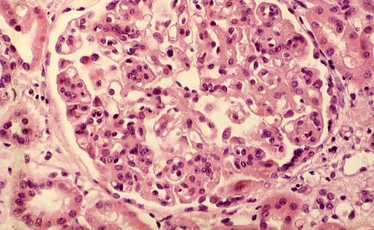 Glomerulonefrite MembranoproliferativaTipo I Ispessimento delle pareti capillari;aumento della cellularità