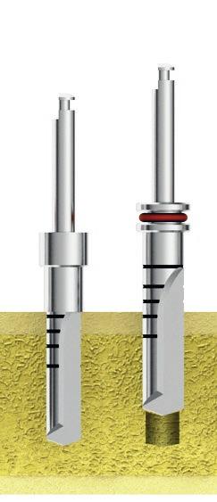 Sequenza per posizionamento CYROTH-EE Ø5 L. 13mm Utilizzare la fresa lanceolata per rompere la corticale e creare l invito necessario per le drill sucessive.