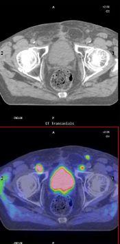 Studio prospettico OSR: Tomoterapia ipofrazionata guidata dalla PET/TAC con (11)C
