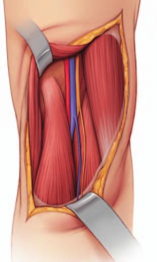 4 Ritrarre il muscolo semimembranoso Identificare il muscolo semimembranoso e ritrarlo medialmente. Diventa visibile l origine della testa mediale del gastrocnemio.