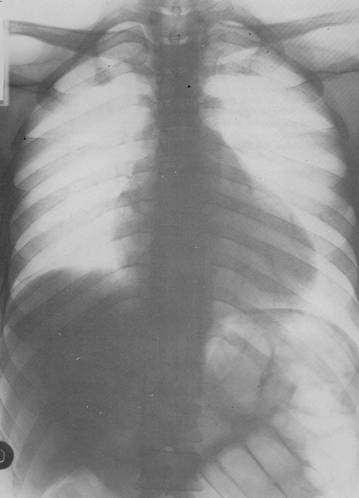 Articolazioni sterno-claveari equidistanti dalla linea mediana Fig. 3-258 pag.