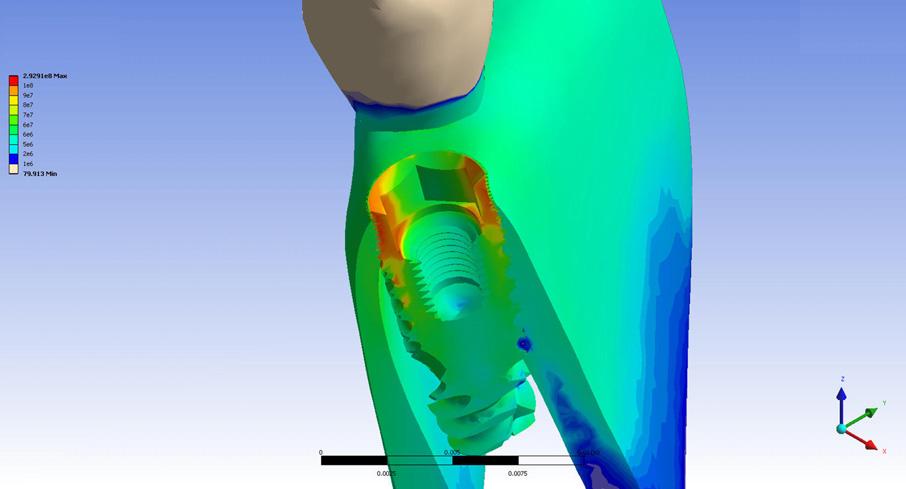 Analisi agli elementi finiti per la definizione della distribuzione degli stress meccanici negli impianti Tabella I Proprieta meccaniche dei materiali utilizzati nella stimolazione biomeccanica