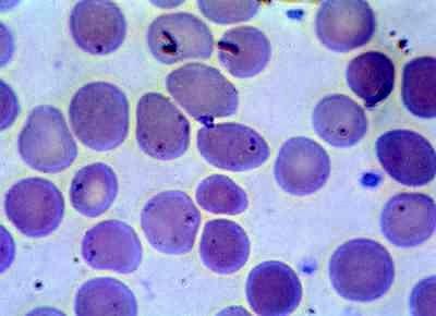 TALASSEMIA MAJOR o MORBO di COOLEY o ANEMIA MEDITERRANEA (omozigosi per la beta-talassemia) Esame emocromocitometrico di soggetti sani e di portatori sani di microcitemia TALASSEMIA MINIMA o