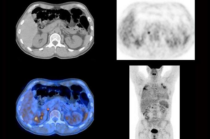 PET - CT