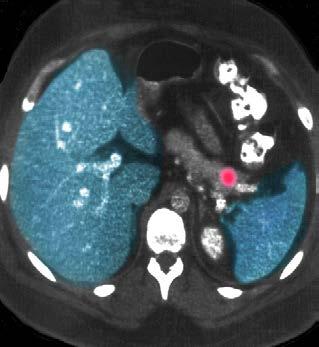 In-Pentetreotide