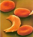 non polare) si trova al posto di un ACIDO GLUTAMICO (AA polare carico). Anemia falciforme (1) («Sickle cell anemia») VALINA Ac. GLUTAMICO http://thesecretoftheblood.