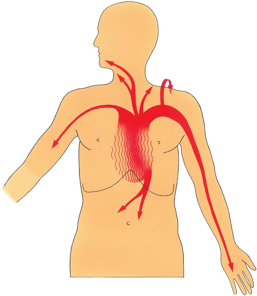 Figura 1: Localizzazione dell angina pectoris La superficie tratteggiata evidenzia la localizzazione più frequente, dietro lo sterno. Le frecce indicano le zone a cui può irradiarsi il dolore.