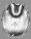 ferro (F: gangli della base, G: substantia nigra and nucleo rosso, H: nuclei dentati). H Tabella 2.