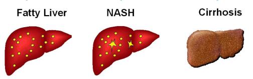 Storia naturale della Steatosi Epatica