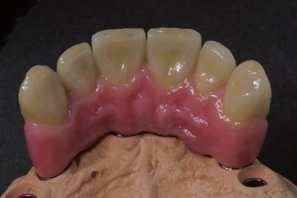 INTRODUZIONE PERFEZIONE IN BIANCO E ROSA Creation ZI Gingiva è una ceramica per veneer per tutti i tipi di armature in ossido di zirconio sia sinterizzato che sottoposto a pressatura isostatica a