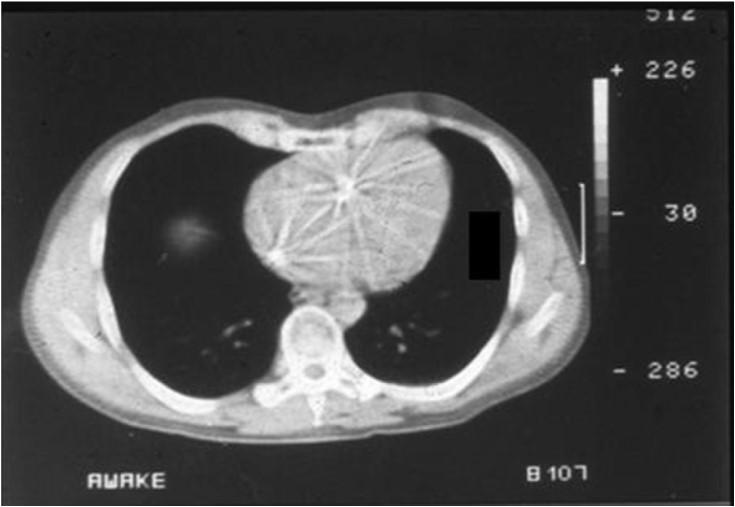 Before induction 15-20% collapse lung during