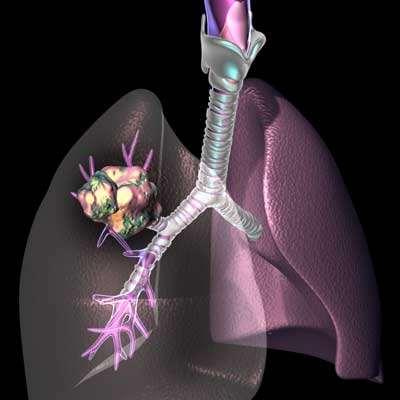 translocation Identify Prevent Treat