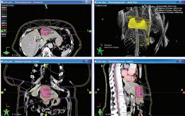 Stereotactic body radiotherapy for colorectal liver metastases: toxicity Radiation-induced liver disease, which presents with