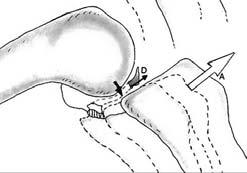 posteriore del menisco interno sotto il condilo