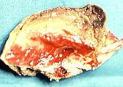 Indicazioni alla fibrinolisi Ischemia acuta da trombosi su vaso ats (associata PTA e/o correzione chirurgica) Occlusione fresca di by-pass ( < 2 settimane) (associata PTA e/o correzione chirurgica)