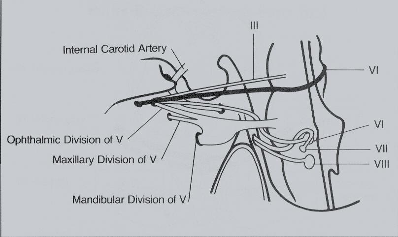 COINVOLGIMENTO 3 NERVO CRANICO Arteria Carotide Interna Divisione Oftalmica del V