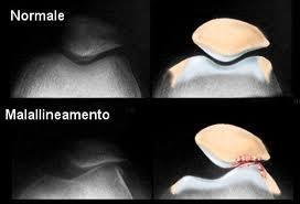 prevede interventi chirurgici ma il potenziamento della parte dell'articolazione non lesionata: la stabilità articolare infatti è data dall'interazione tra 3 sistemi: sistema legamentoso, sistema