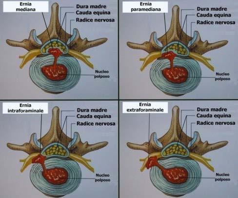 PER IL PAZIENTE 3 di 16 (contenuta), alla rottura o meno del legamento longitudinale posteriore (sottolegamentosa, translegamentosa, retrolegamentosa) e in base alla migrazione in senso caudale o