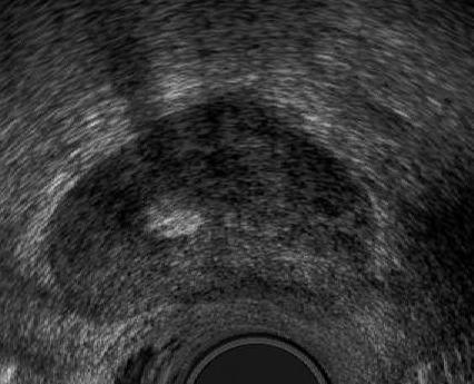 High Intensity Focused Ultrasound TURP pre