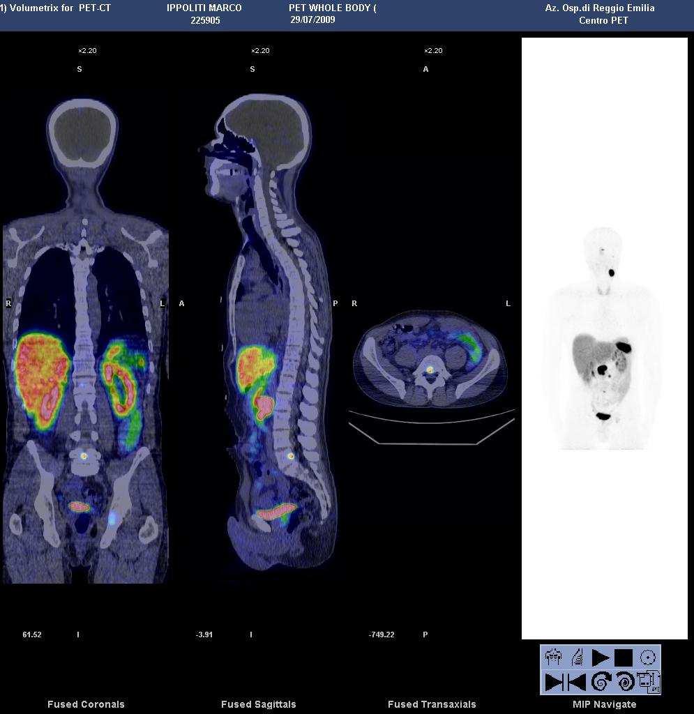 Paraganglioma