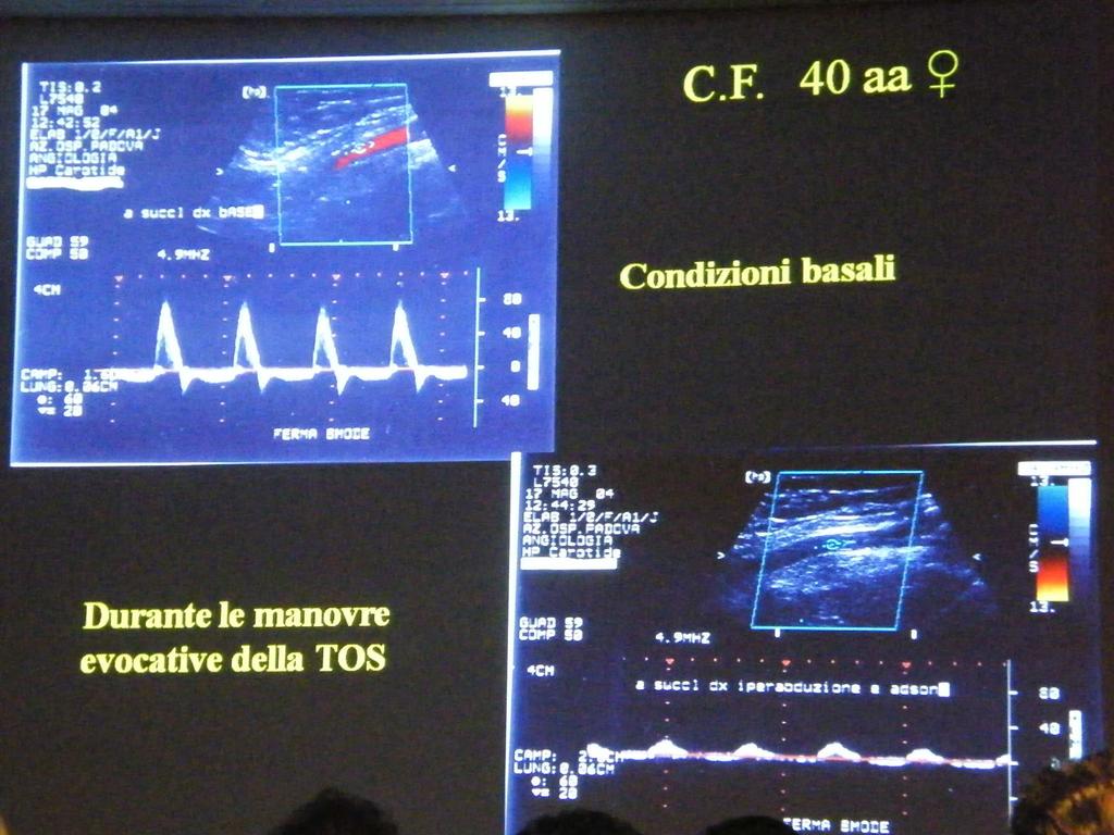 Sindrome dello stretto toracico (TOS = Thoracic Outlet Svndrome).