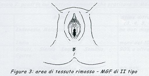 MGF II