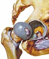 La malattia dell anca L articolazione dell anca è costituita da una sfera (rappresentata dalla testa del femore) libera di muoversi in una coppa situata nel bacino (acetabolo).