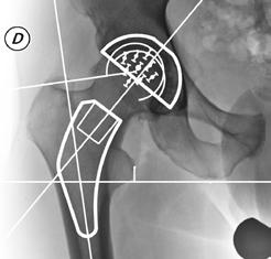 L impiego di uno stelo femorale di piccole dimensioni determina una minore occupazione del canale femorale, consente minori resezioni ossee e rende sicuramente più facile un eventuale futuro