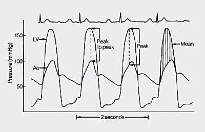 consumo di ossigeno nell unita di tempo (L/min) e la differenza arterovenosa di ossigeno (vol%), è agevole ricavare la gittata cardiaca (L/min).