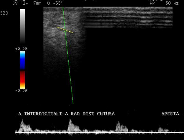 Determinazione flusso arterie interdigitali simulazione chiusura a. rad. distale (LARD) E.