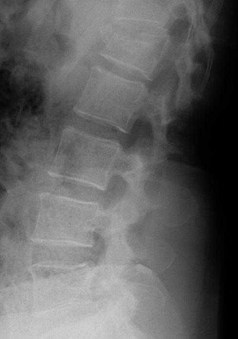 L'area di applicazione nei pazienti affetti da trauma o patologia tumorale è di regola a livello dell'articolazione toraco-lombare (T12/L1), ma può estendersi da T6 fino al sacro (S1).