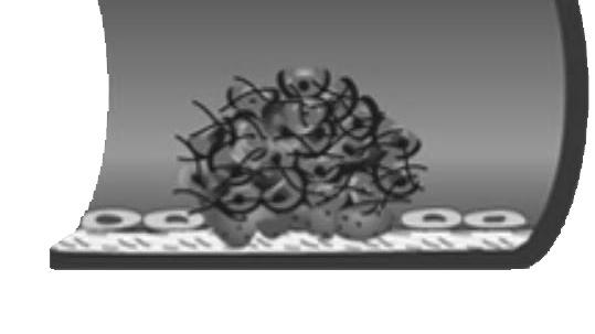 t-pa Plasmina Dissoluzione del