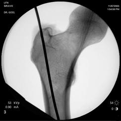 6 Inserire il filo guida Strumenti 357.399 Filo di guida da B 3.2 mm, lunghezza 400 mm 393.100 Mandrino universale con impugnatura a T 03.010.505 Boccola di protezione 17.