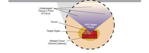 Pancreat Dis Int 2012 Median OS: 10 mesi Gao HF Hepatogastroenterology 2013 Median OS: 11 mesi Anzidei M Invest