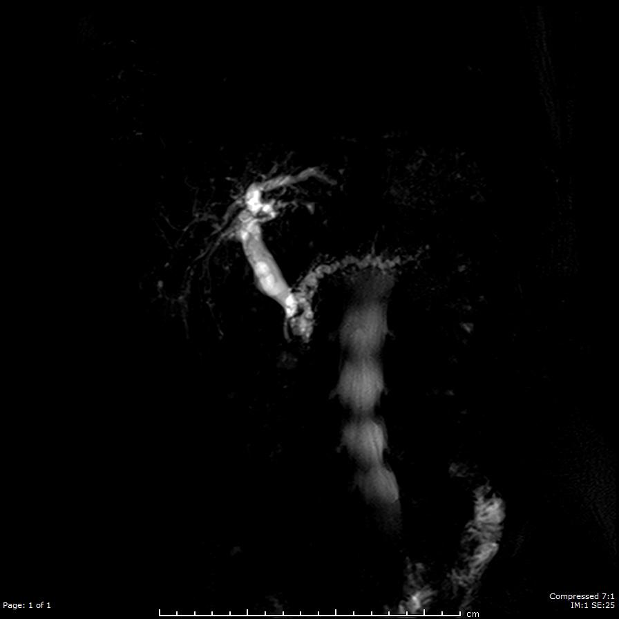 chemioterapia (IAC) Selective arterial