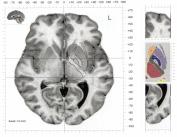 COS E IL NEUROIMAGING MEDICO-NUCLEARE Radiofarmaci per l Imaging Funzionale Immagini della Distribuzione corticale e sottocorticale del 18F-Deossi Glucosio (metabolismo cerebrale regionale) e del