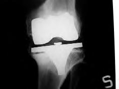La protesi totale di ginocchio a piatto mobile INTRODUZIONE Tra le cause di fallimento delle protesi di ginocchio quella sicuramente più importante è l osteolisi, dovuta al debris del polietilene
