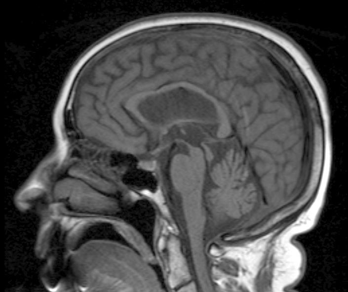 PSP: MRI