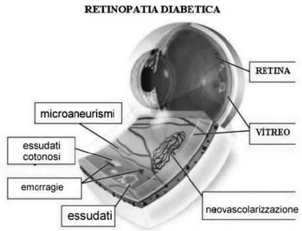 Materiali e metodi I vari aspetti fluoroangiografici sono stati come segue: Stadio 0 = non segni di retinopatia Stadio 1 = microaneurismi (particolari lesioni dei capillari) <5