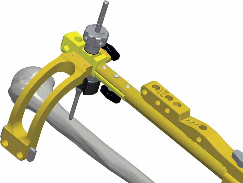 TECNICA OPERATORIA 33 Rimuovere la punta perforatore cannulata, il filo di Kirschner e la guida di stabilizzazione.