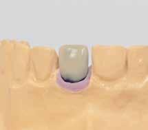 MONCONI IN TITANIO PROTESI CEMENTATA 1 Eseguire il modello master, inclusa una mascherina 2 gengivale.