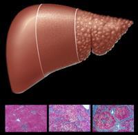 LIVER DISEASE PROGRESSION WITH HCV Normal liver or Minimal hepatitis Chronic inflammation and fibrosis Cirrhosis and Portal