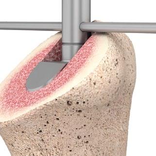 si ottiene la versione corretta allineando il pin guida di orientamento nel foro sotto le lamelle di taglio dell'osteotomo con il piano di resezione (Figura 6a).