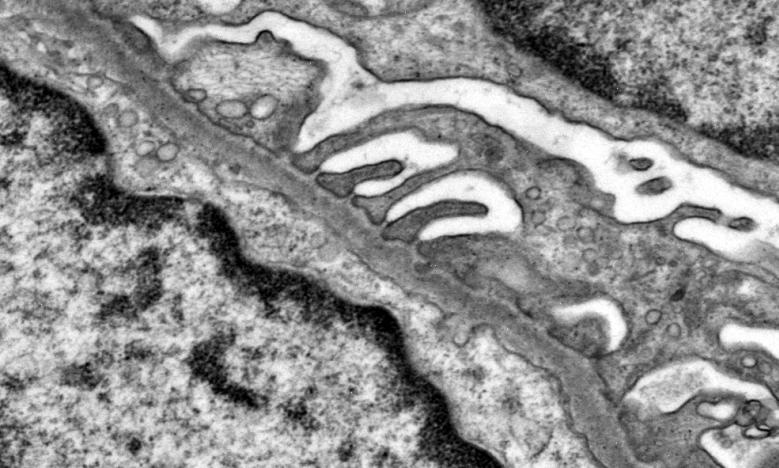 ALTERAZIONI DELLA MEMBRANA BASALE GLOMERULARE