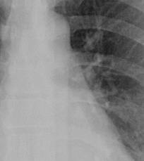 Anatomia ilo SN Proiezione frontale Ilo polmonare Corno superiore arteria