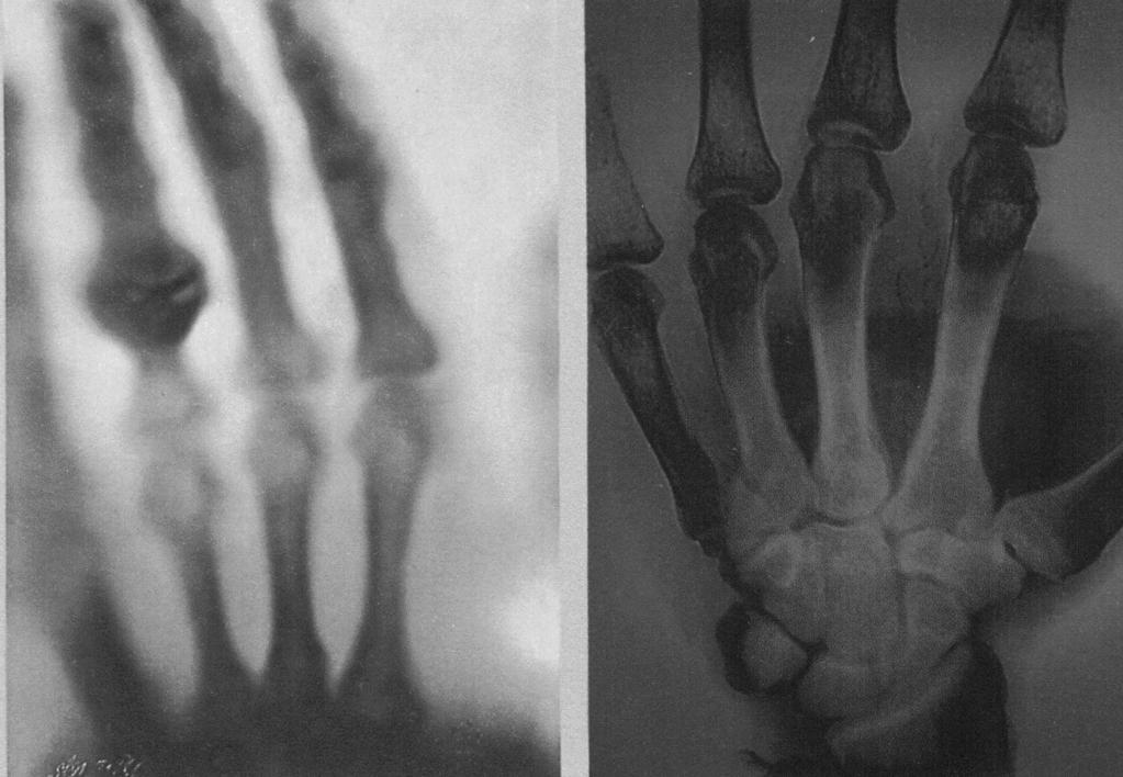 Scoperti da Roentgen nel 1872 Imaging: paziente