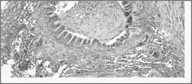 Pathological Findings in